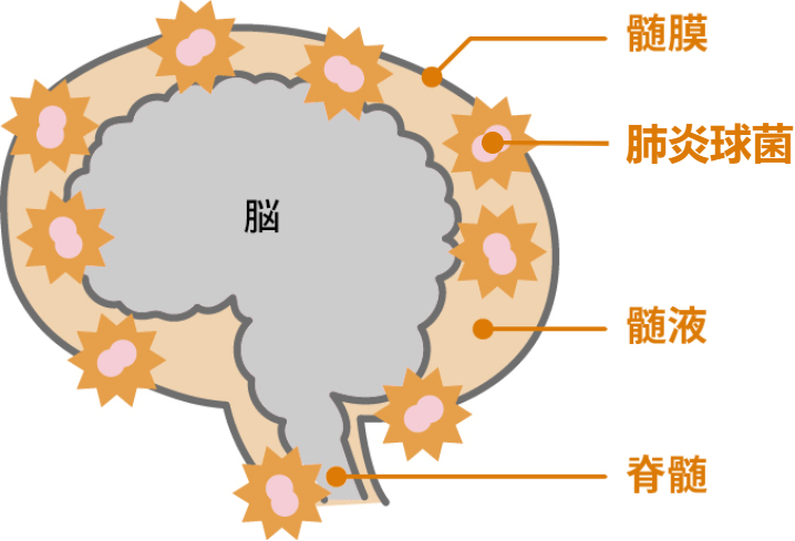 細菌性髄膜炎ってどんな病気