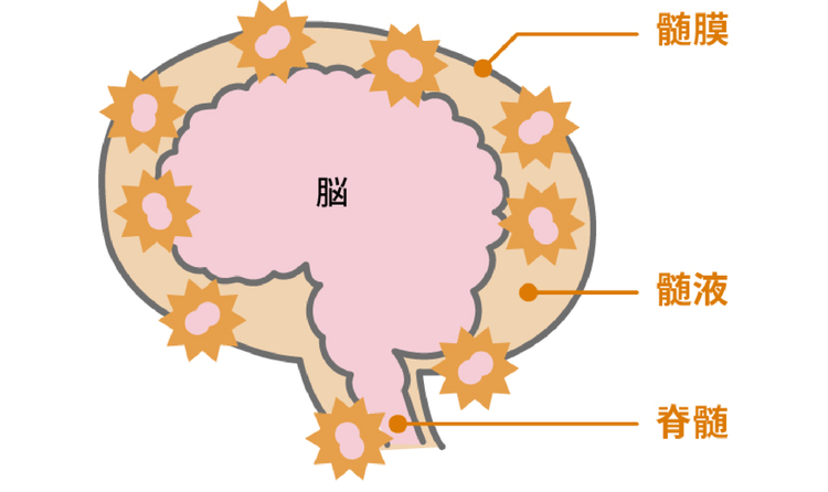 細菌性髄膜炎の主な原因の1つは、肺炎球菌です
