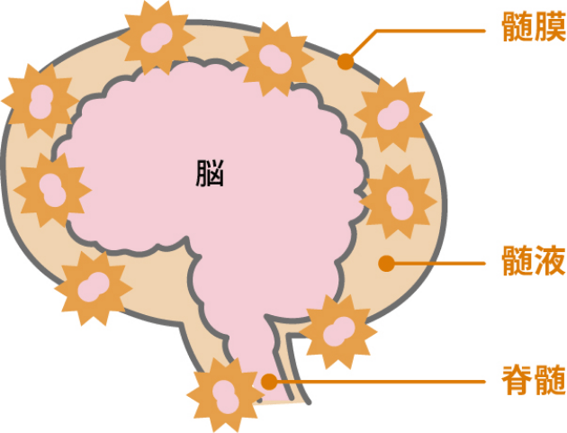 細菌性髄膜炎の主な原因の1つは、肺炎球菌です