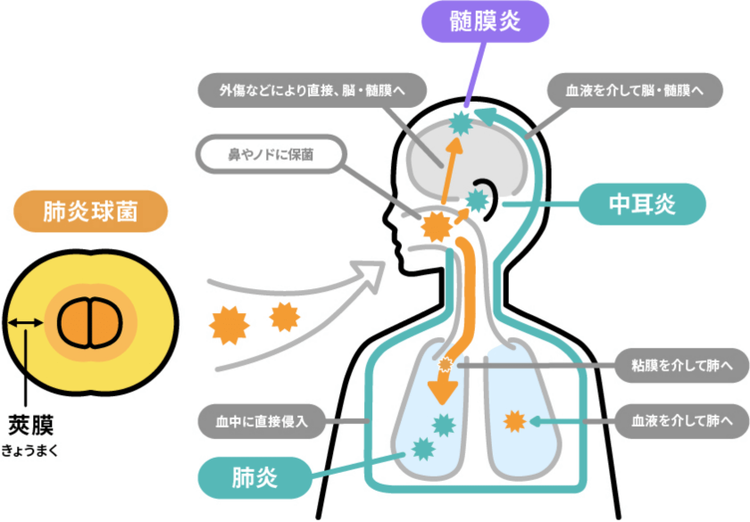 肺炎球菌が引き起こしやすい病気について